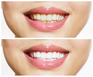 Teeth-Whitening-or-Bleaching