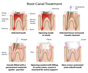 Root Canal Treatment Endodontics